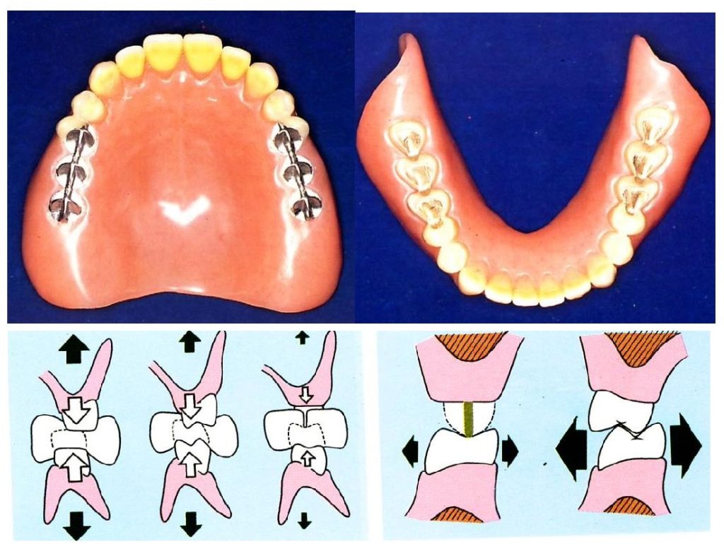 SAブレード臼歯